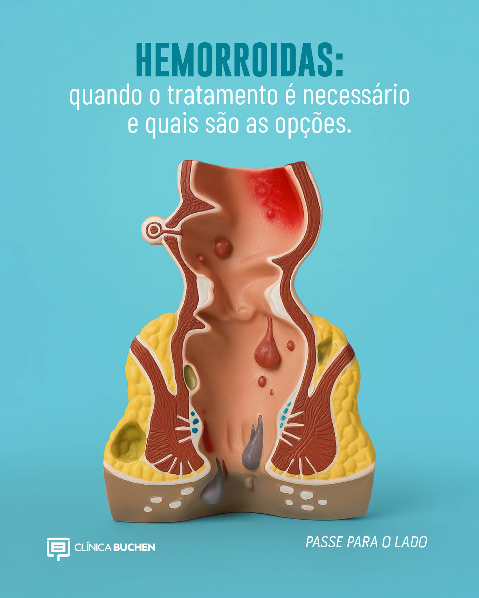 Hemorroidas: quando o tratamento � necess�rio e quais s�o as op��es?